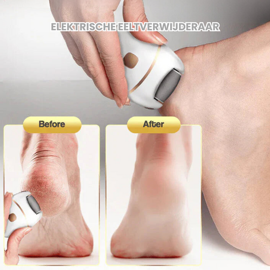 SoftStep™-Elektrische Eeltverwijderaar